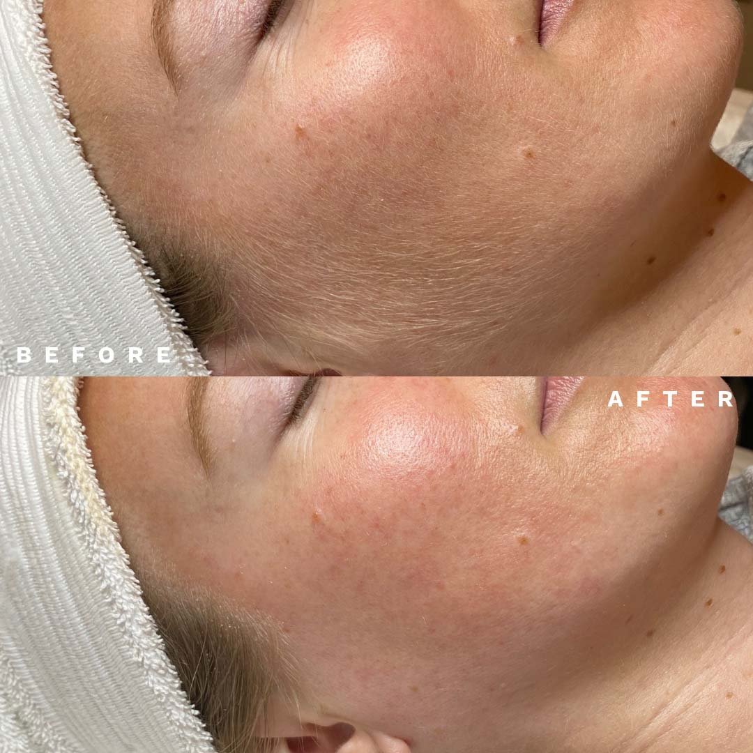 Before and after dermaplaning, showing brighter, smoother skin